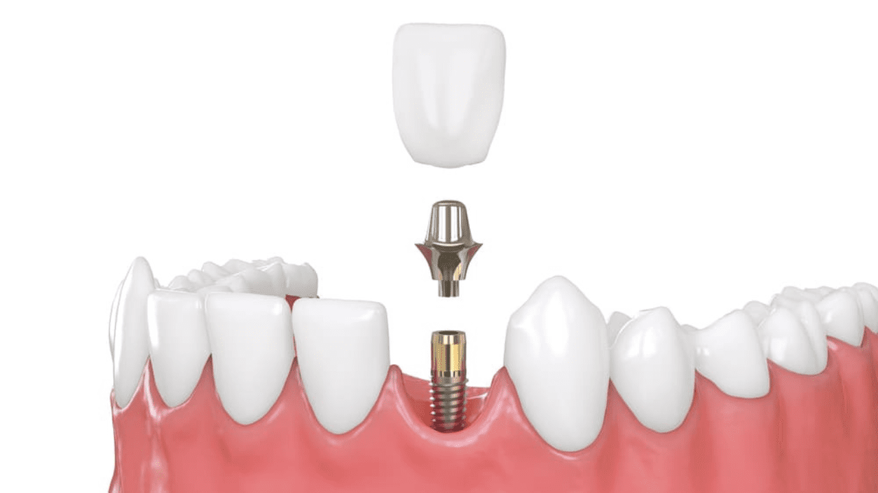 All You Need To Know About AD-Abutments | Products, Process & Variety | ADE