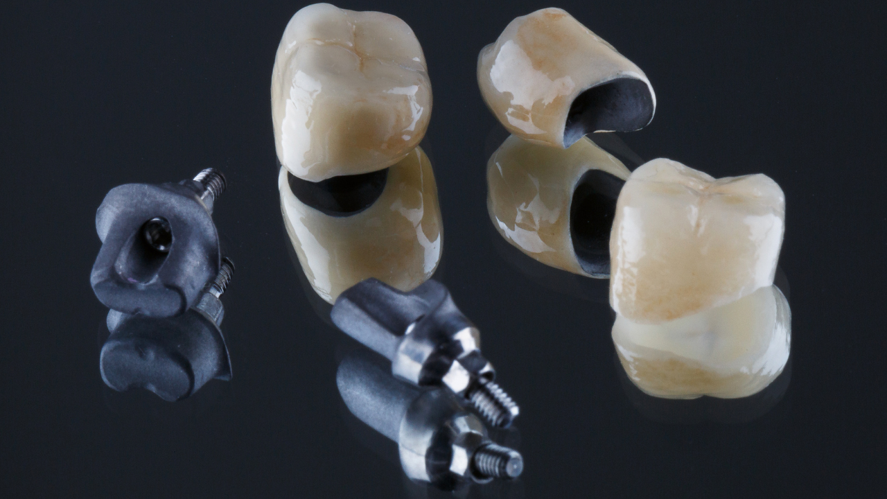 PFM Crowns: The Reliable Choice for Restorative Dentistry