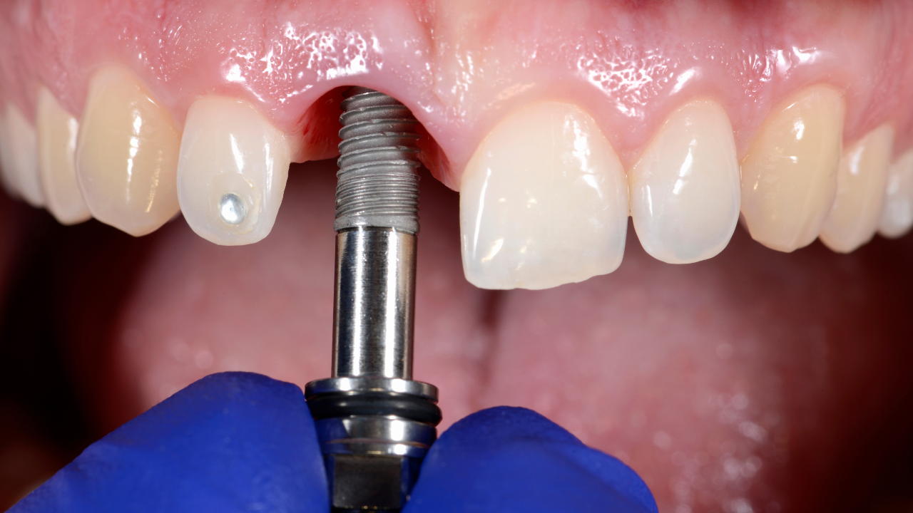 Tilted vs. Straight Dental Implants: Which One's Right for You?