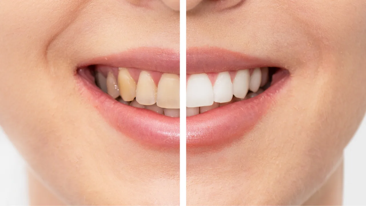 Teeth Whitening Methods for Sensitive Teeth - Best Options 2025