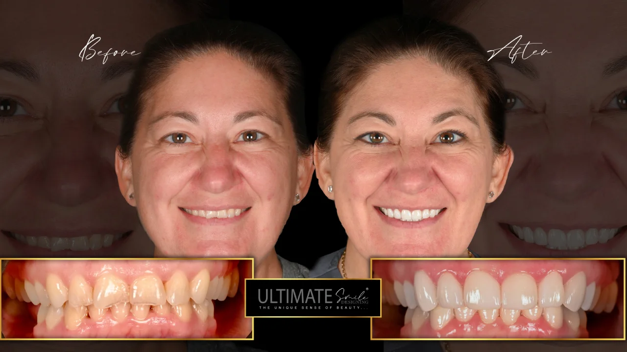 Cosmetic Dentistry Advancement: CAD/CAM, Laser Dentistry & AI